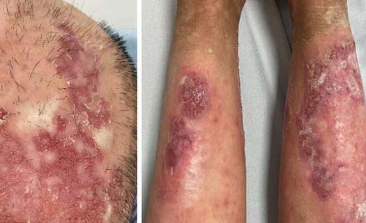 Phương pháp trị bệnh da liễu hiếm gặp