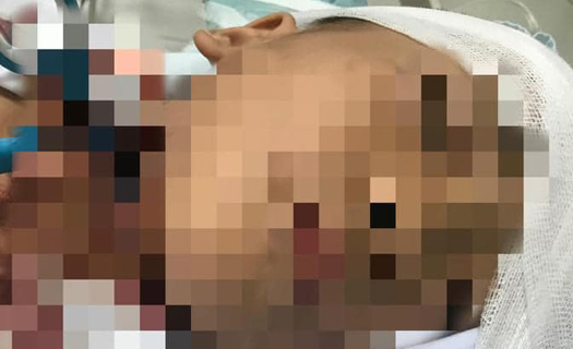 Bệnh viện Nhi Trung ương: Kịp thời cứu sống bé trai bị kéo đâm xuyên cổ