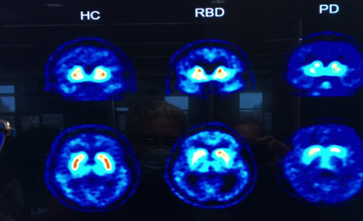 Bệnh nhân Covid-19 có nguy cơ mắc chứng Parkinson